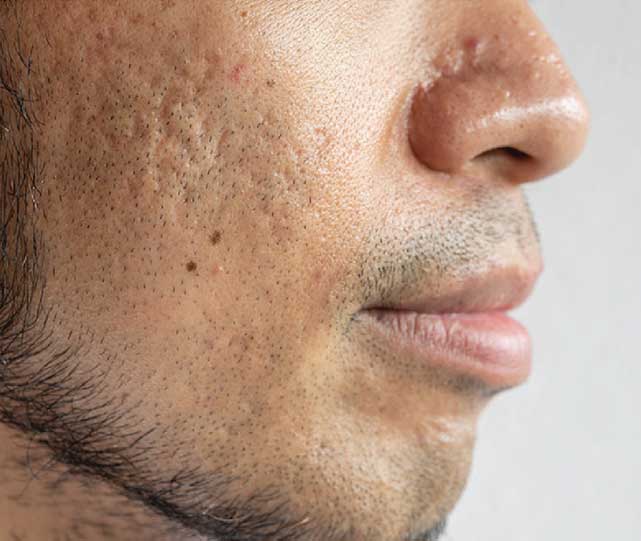 SkinPen microneedling treatment — 4