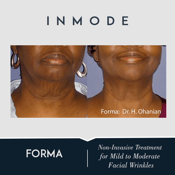 Forma skin tightening before and after