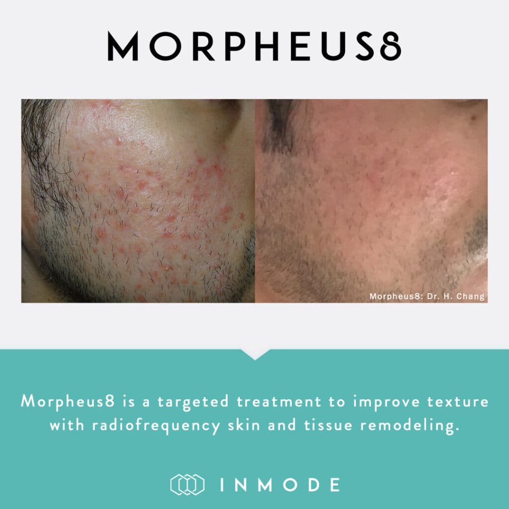 Morpheus8 acne treatment result