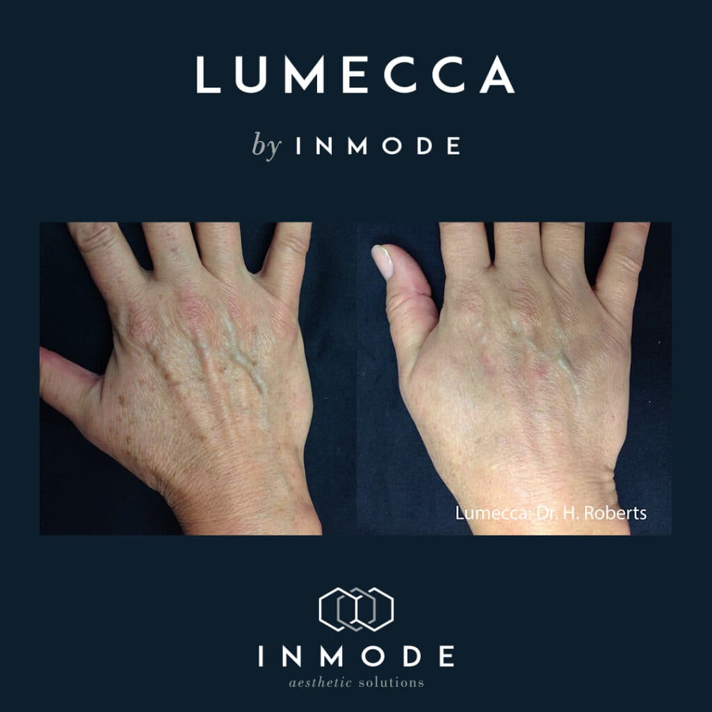 Lumecca IPL result on the hand