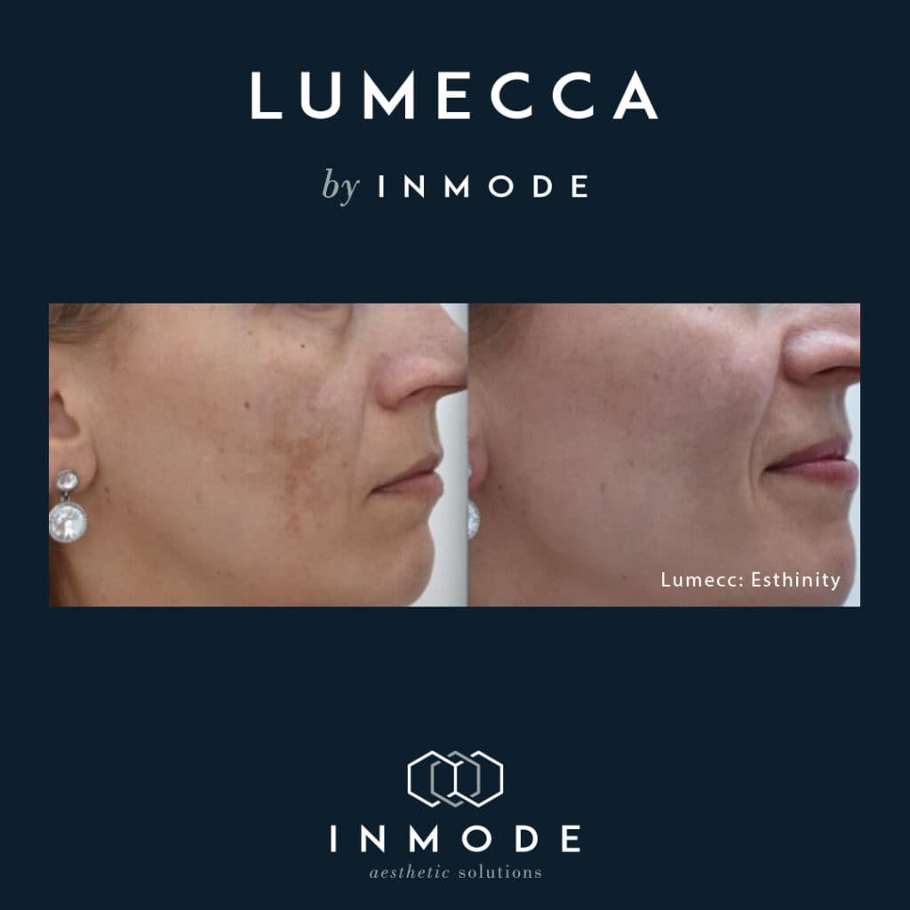 Lumecca IPL