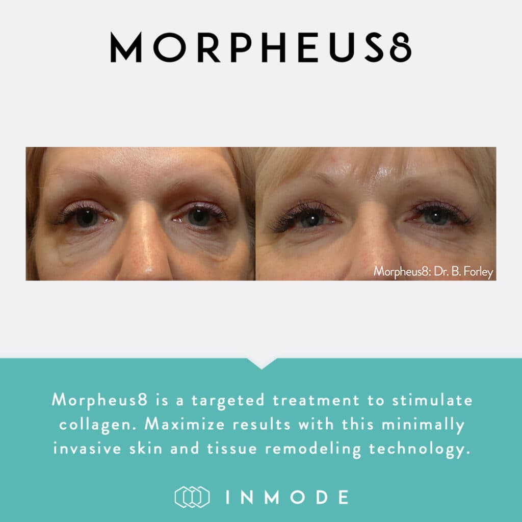 Morpheus8 before and after