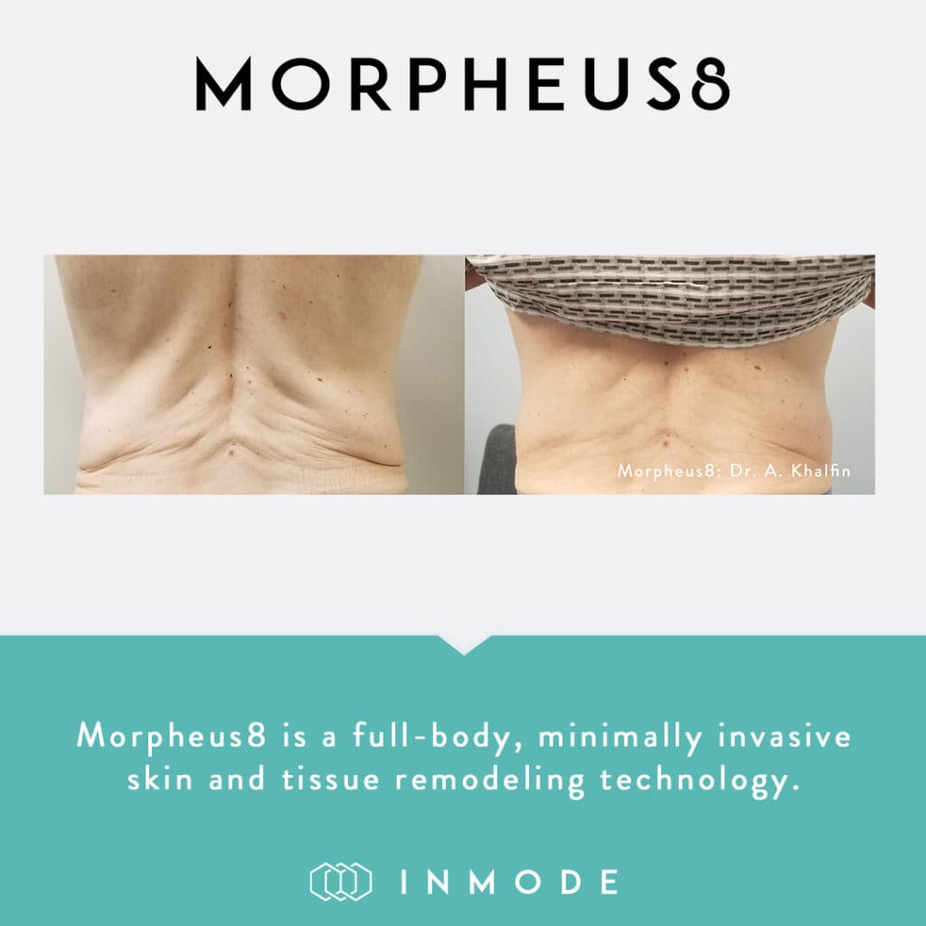 Morpheus8 before and after